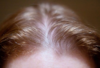 head hair 400x271 اعادة انبات الشعر بمقدمة الرأس للنساء
