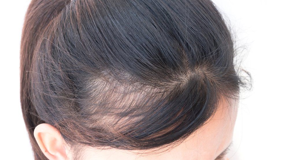 أسباب تساقط الشعر عند المرأة